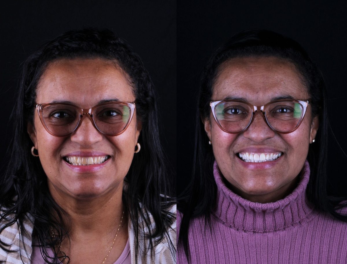 Antes e depois - paciente Andreia
