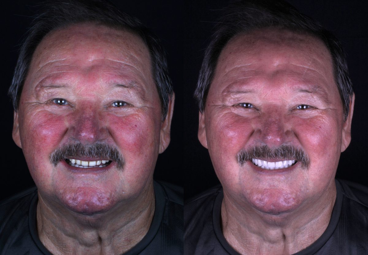 Antes e depois - paciente Fernando