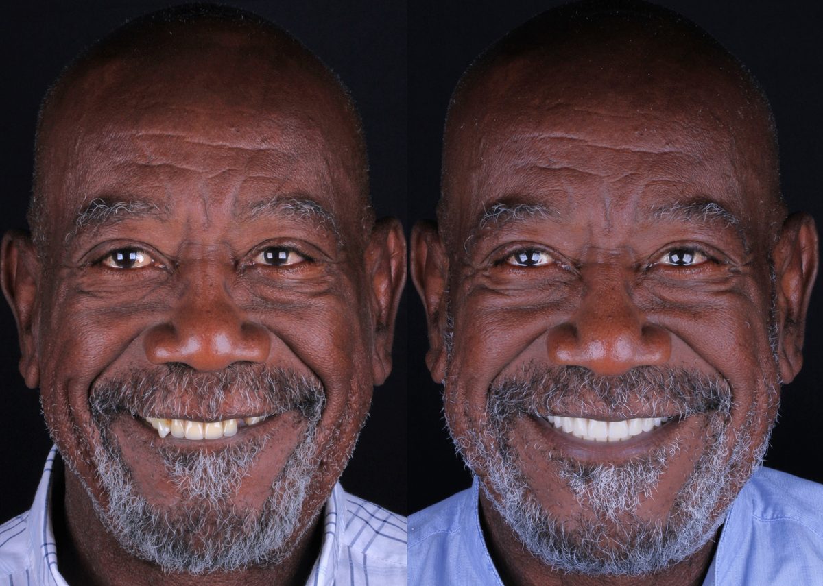 Antes e depois - paciente José Renato