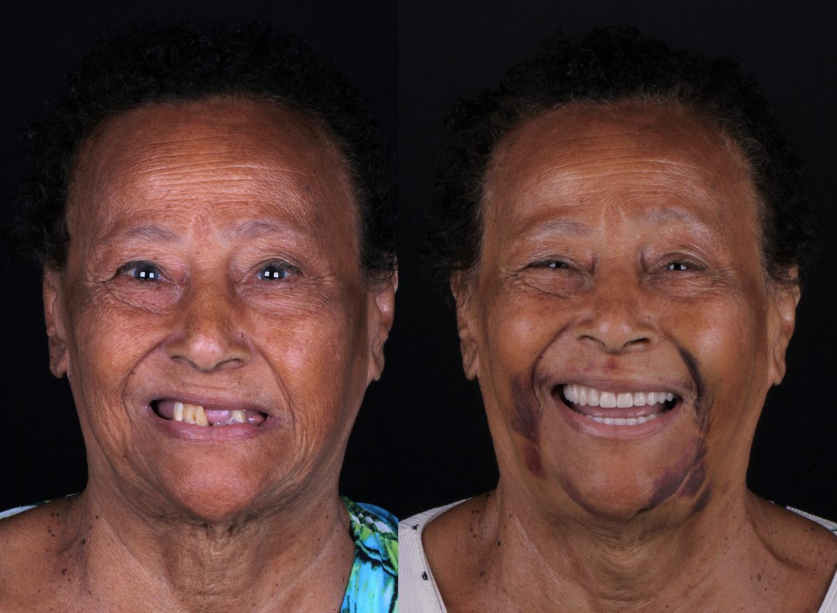 Antes e depois - paciente Maria Helena