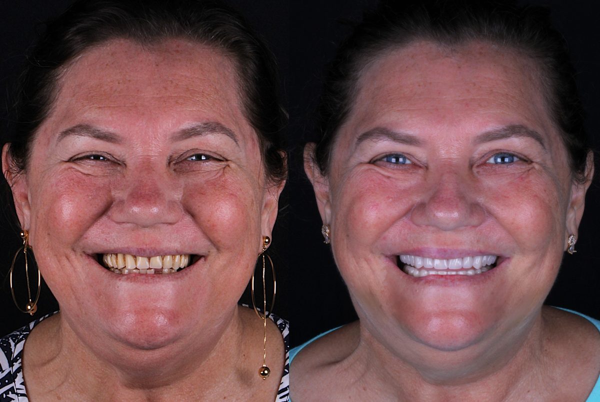 Antes e depois - paciente Marilene