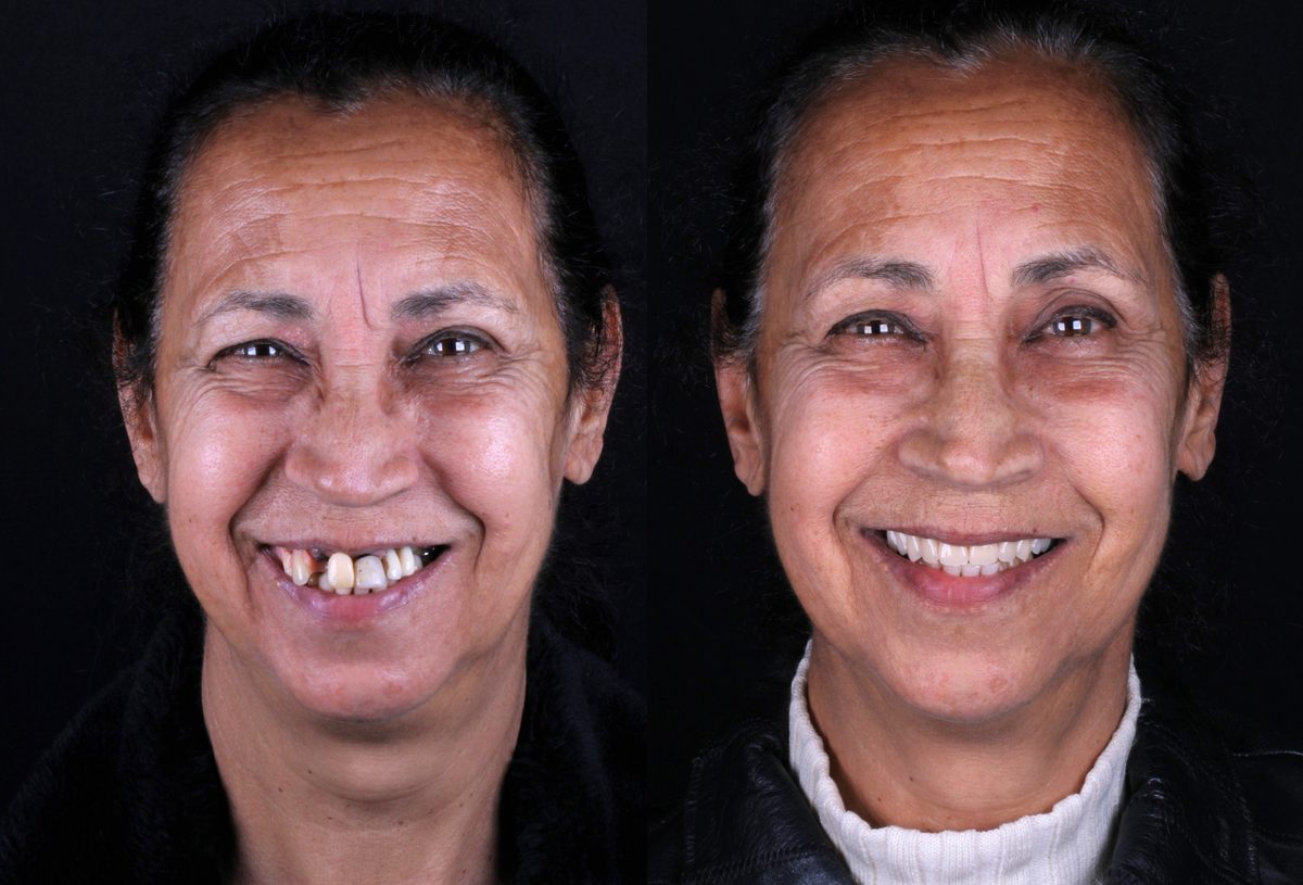 Antes e depois do tratamento odontológico - paciente Marta